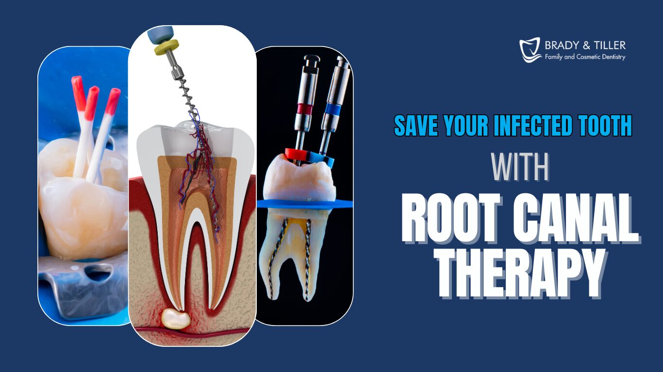 Root Canal - Charlotte, Nc