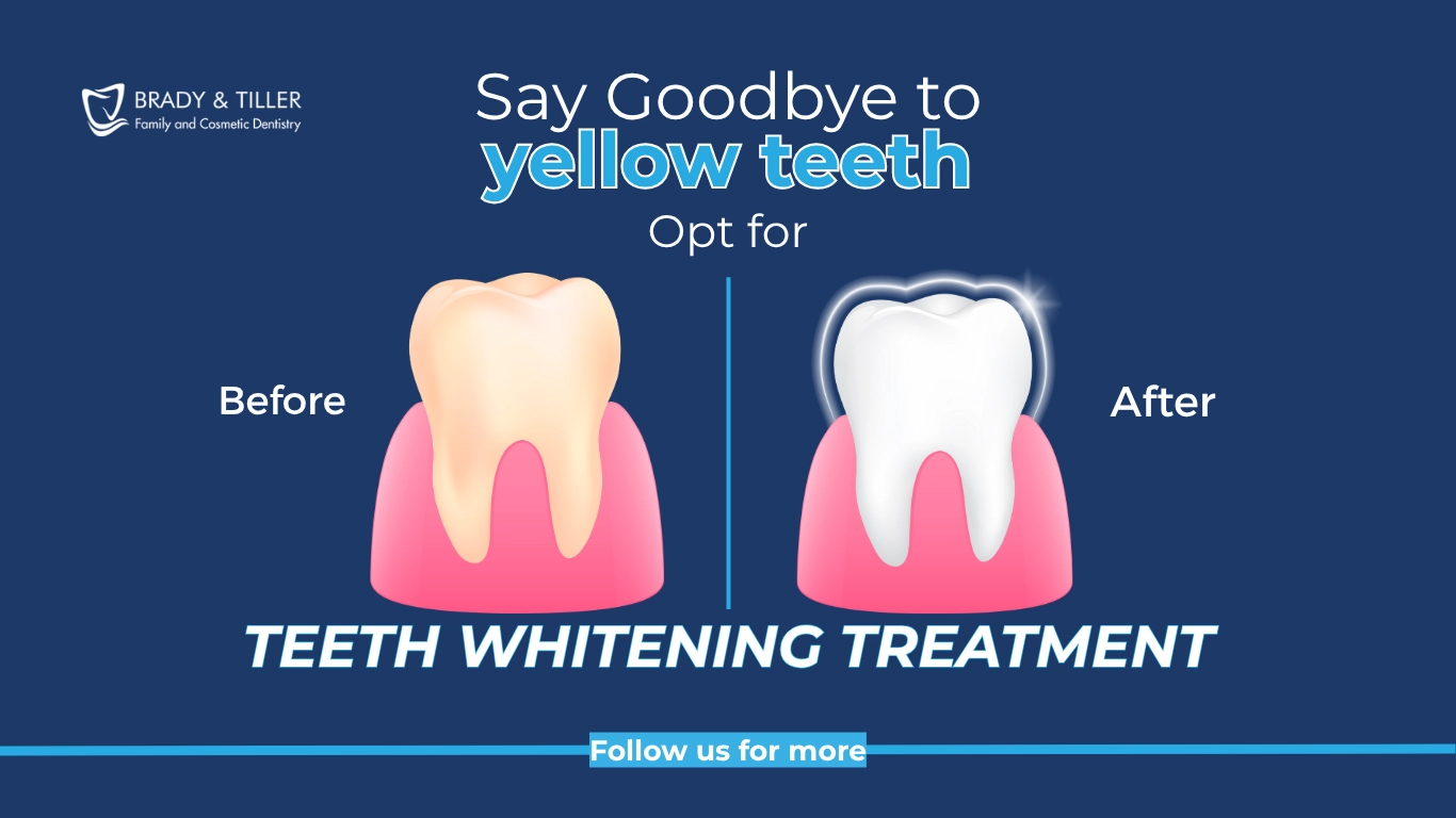 Brady_Teeth Whitening